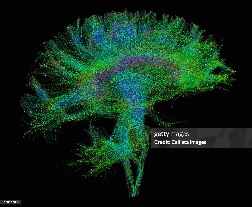 Diffusion MRI, also referred to as diffusion tensor imaging or DTI, of the human brain