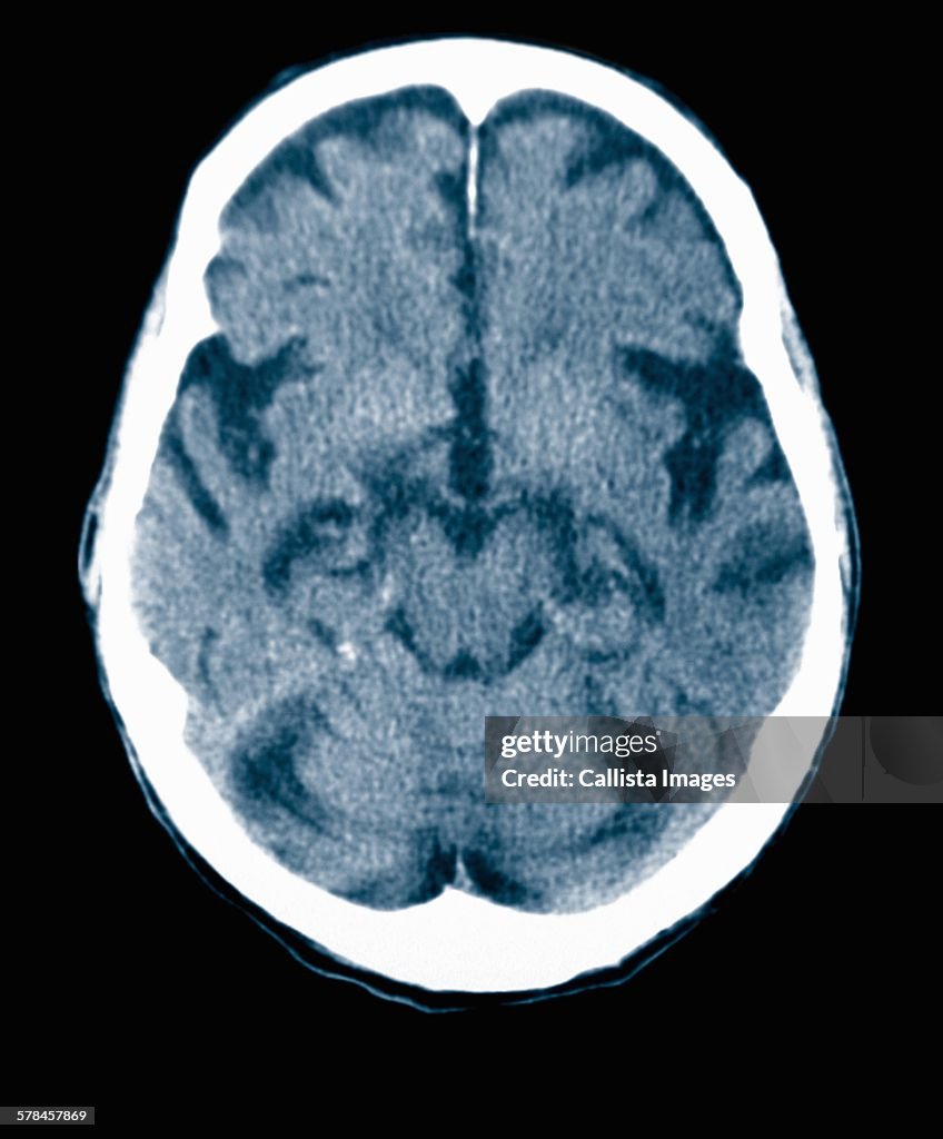 CT scan 84 year old male with Alzheimers disease. CT shows brain atrophy with small gyri and large sulci