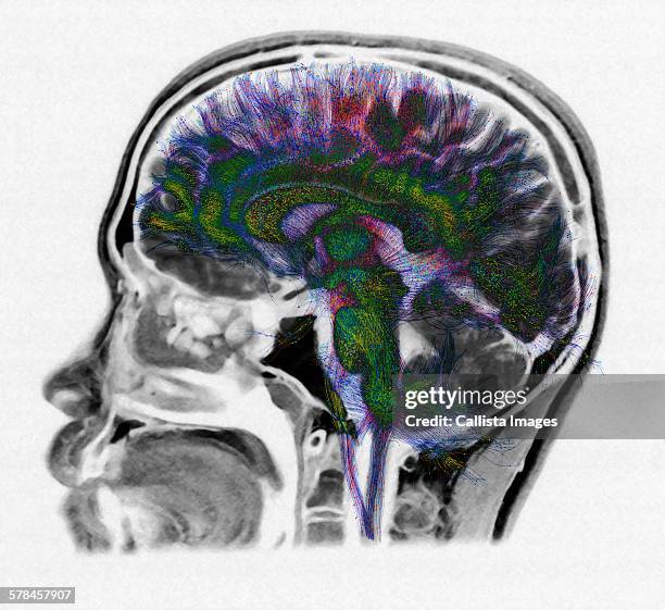 Diffusion Tensor Mri Photos and Premium High Res Pictures - Getty Images