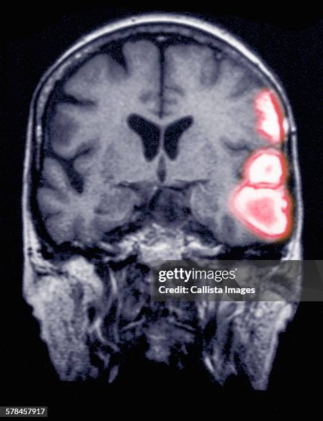 temporoparietal brain hemorrhage in a 77 year old female shown on an mri scan - petechiae stockfoto's en -beelden