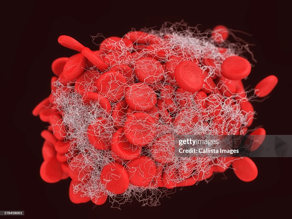 Illustration of a blood clot showing a clump of red blood cells intertwined in a fibrin mesh