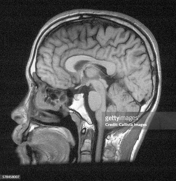 mri of head showing normal brain structures - skull xray no brain stock pictures, royalty-free photos & images