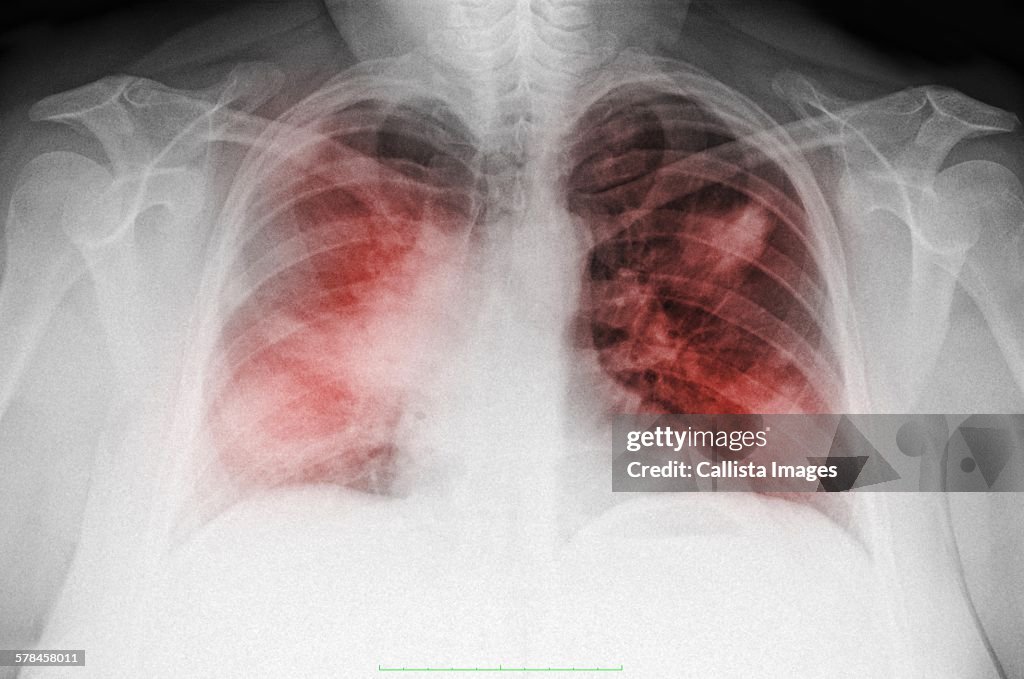 Chest x-ray of a 44 year old woman smoker, PA view, showing diffuse interstitial infiltrates suggestive of an atypical pneumonia