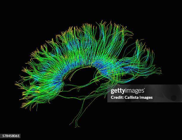 diffusion mri, also referred to as diffusion tensor imaging or dti, of the human brain - scientific imaging technique fotografías e imágenes de stock