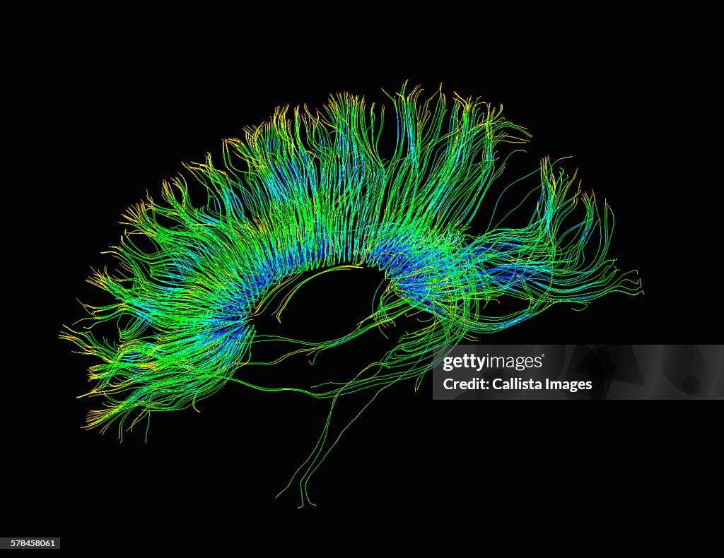 Diffusion MRI, also referred to as diffusion tensor imaging or DTI, of the human brain