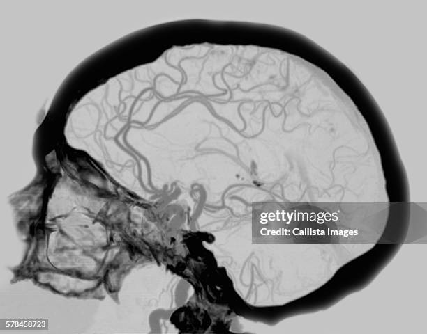 angiogram ct showing the blood supply of the brain, including the circle of willis - ct angiography stock pictures, royalty-free photos & images