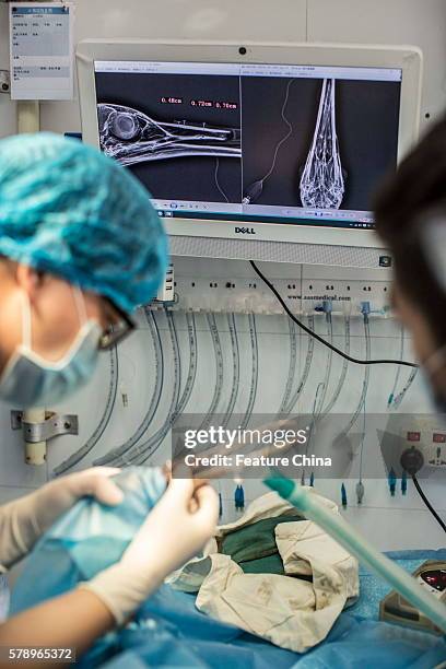 Medical staff fixes the new titanium upper beak on a red-crowned crane named Li Li in an animal hospital on July 10, 2016 in Guangzhou, China. The...