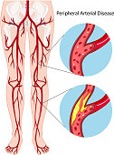 Peripheral arterial disease diagram
