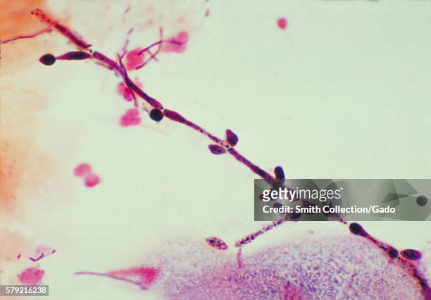 This is a photomicrograph of a vaginal smear identifying Candida albicans using gram-stain technique, 1976. Candida albicans lives in numerous parts...