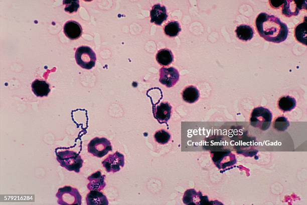 This is a photomicrograph of a blood culture specimen, depicts numbers of Gram-positive, a-hemolytic viridans streptococci group bacteria, most of...