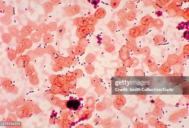 This photomicrograph reveals cocci-shaped Enterococcus sp. Bacteria taken from a pneumonia patient, 1978. Enterococcus sp. Is a common, Gram-positive...