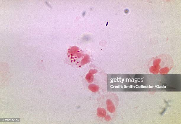 This photomicrograph depicts Neisseria gonorrhoeae bacteria within a neutrophil, 1972. N. Gonorrhoeae, a gram-negative diplococcus, is the causative...