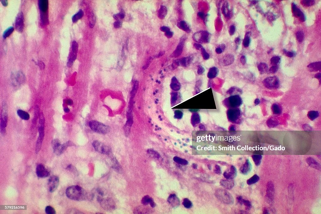 Strongyloides Stercoralis