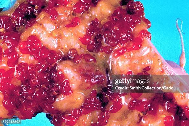 Monkey Colon This colon specimen from a rhesus monkey shows inflammation caused by ...