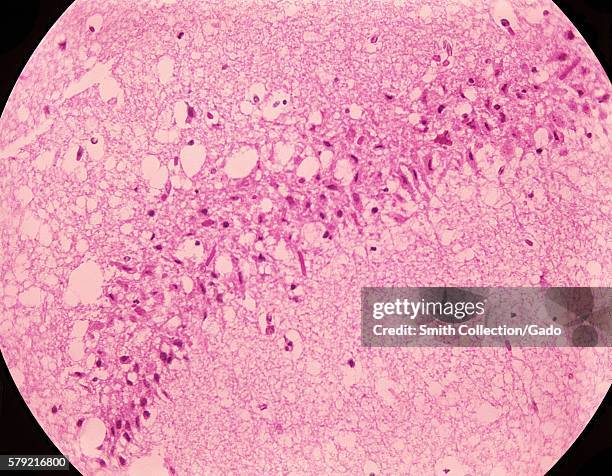 This photomicrograph of mouse brain tissue after dying of Venezuelan Encephalitis reveals neural necrosis and edema, 1971. First recognized in the...