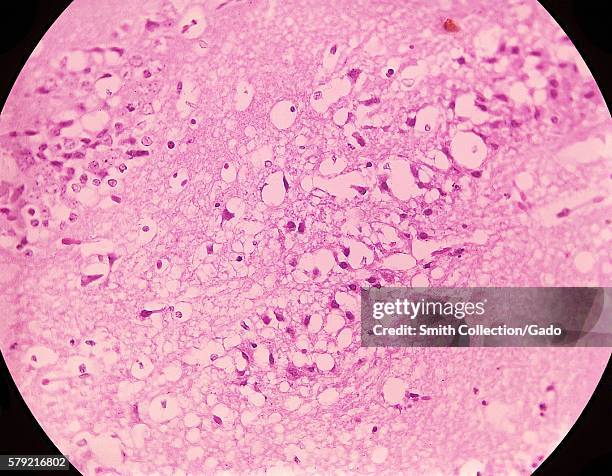 Magnified 300X, this photomicrograph of mouse brain tissue after dying of Venezuelan Encephalitis, reveals neural necrosis and edema, 1971. First...