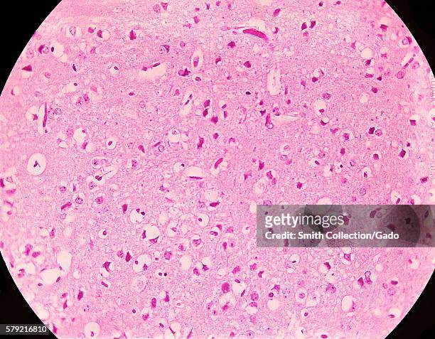 Magnified 300X, this photomicrograph of mouse brain tissue after dying of Venezuelan Encephalitis reveals neural necrosis and edema, 1971. First...
