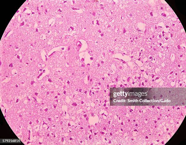 Magnified 300X, this photomicrograph of mouse brain tissue after dying of Venezuelan Encephalitis reveals neural necrosis and edema, 1971. First...