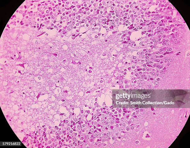 Magnified 300X, this photomicrograph of mouse brain tissue after dying of Venezuelan Encephalitis reveals neural necrosis and edema, 1971. First...