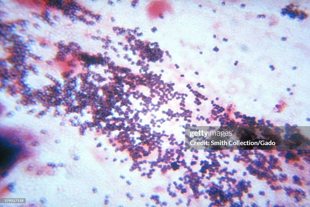 Gram-Positive Diplococcal Organism