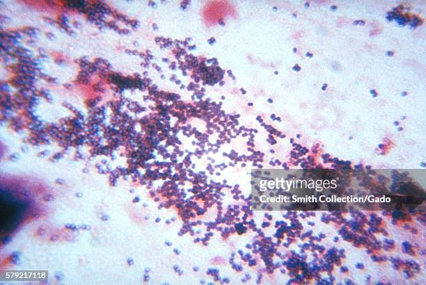This sputum smear shows staphylococcus bacteria using Gram stain technique in a patient with staphylococcal pneumonia, 1963. Staphylococcus aureus is...