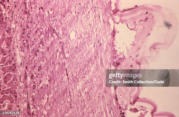 This is a photomicrograph of Echinococcus vogeli taken from a gorilla at the Los Angeles Zoo, 1978. The larval stage of the microscopic tapeworm...