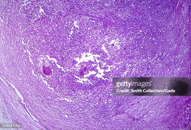 Photomicrograph of heart tissue revealing histopathologic changes due to Actinomyces sp. Bacteria, 1964. Actinomyces spp. Are Gram-positive...