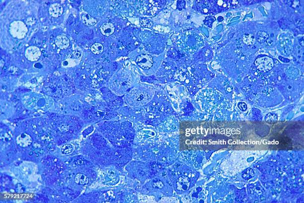 This photomicrograph shows hepatitis caused by the Lassa virus, using toluidine-blue azure II stain, 1972. The Lassa virus, which can cause altered...