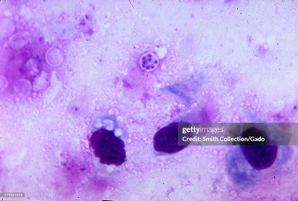 Pneumocystis Jirovecii