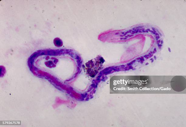 This photomicrograph shows the inner body and cephalic space of a Brugia malayi microfilaria in a thick blood smear, 1977. B. Malayi, a nematode that...