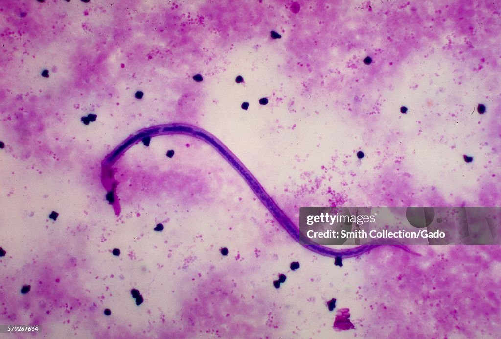 Wuchereria Bancrofti