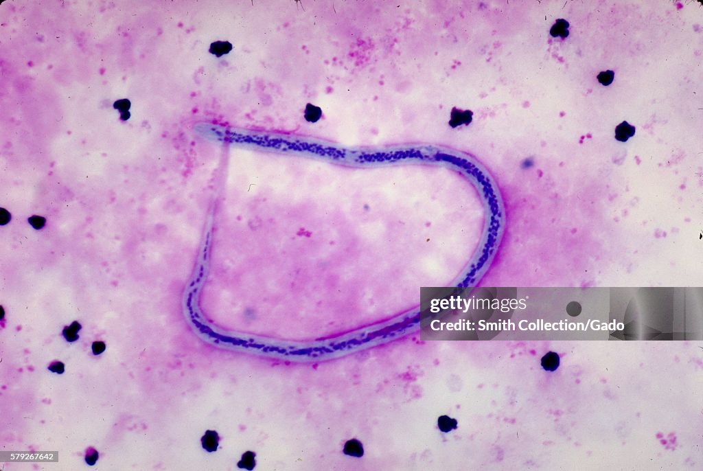 Wuchereria Bancrofti