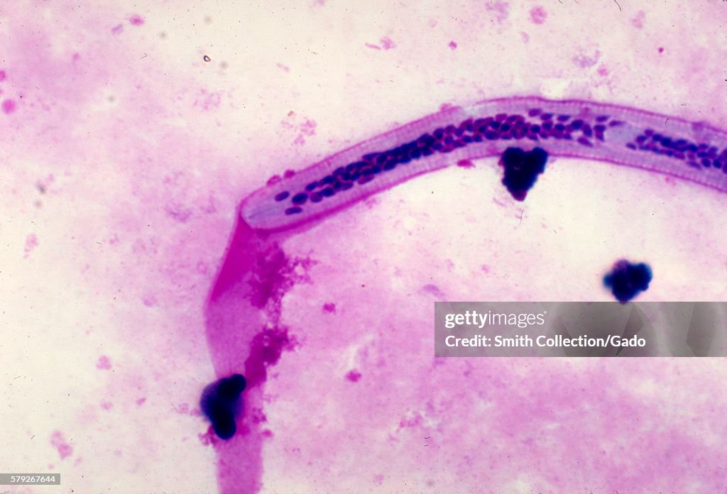 Wuchereria Bancrofti