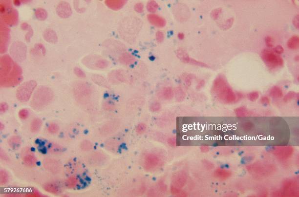 Photomicrograph detecting the presence of hemosiderin, stained blue, within diffuse bone marrow, 1972. Hemosiderin, revealed here using PAS stain and...