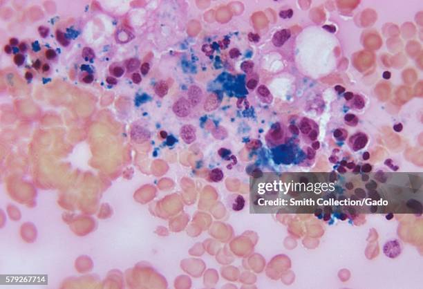 Photomicrograph of bone marrow tissue showing a normal amount of iron stores using Prussian blue staining technique, 1972. Normal iron stores are...