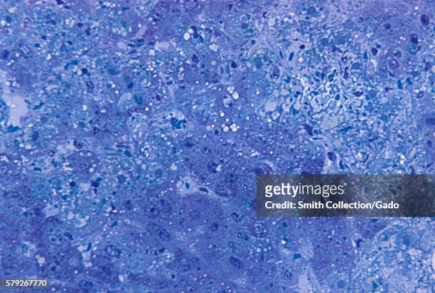 Photomicrograph of hepatitis caused by the Lassa virus, using toluidine-blue azure II stain, magnified 315X, 1972. The Lassa virus can cause altered...