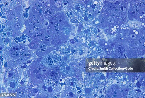 Photomicrograph of hepatitis caused by the Lassa virus, using toluidine-blue azure II stain, magnified 500X, 1972. The Lassa virus can cause altered...