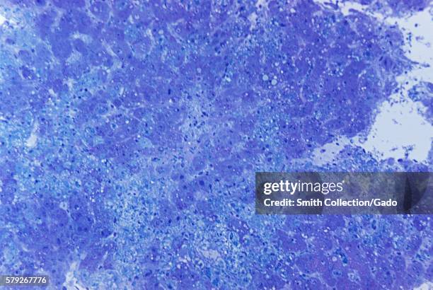 Photomicrograph of hepatitis caused by the Lassa virus, using toluidine-blue azure II stain, magnified 315X, 1972. The Lassa virus can cause altered...