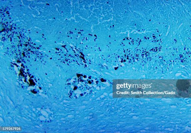 This micrograph depicts the histopathologic changes associated with cryptococcosis of the lung using GMS stain, 1964. Cryptococcosis is transmitted...