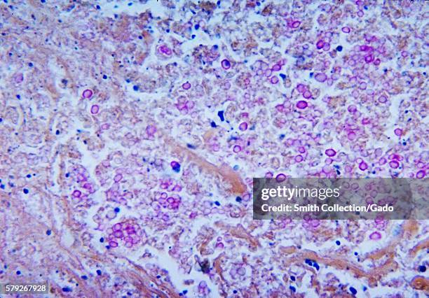 This micrograph depicts the histopathologic changes associated with cryptococcosis of the lung using Mucicarmine stain, 1964. Cryptococcosis is...