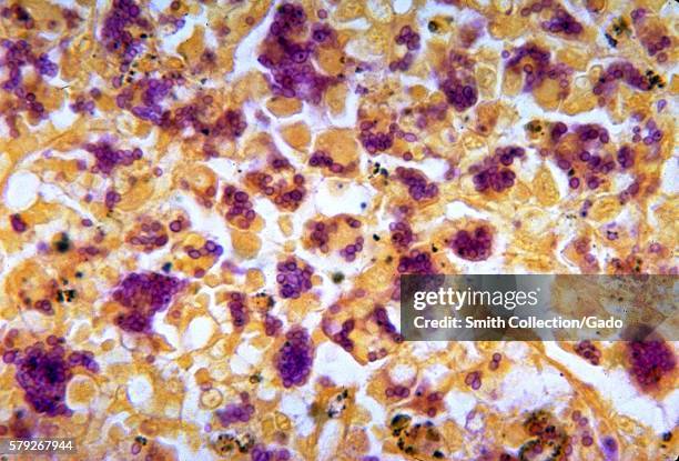 This micrograph depicts the histopathologic changes associated with histoplasmosis of the spleen using Gridley stain, 1964. Positive histoplasmin...