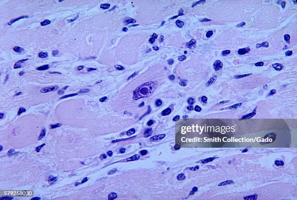 This micrograph reveals an intranuclear inclusion body in a heart section from a patient with diphtheria-related myocarditis, 1965. In approximately...