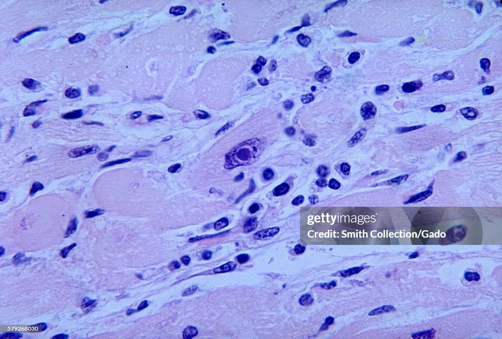 Corynebacterium Diphtheria Bacteria