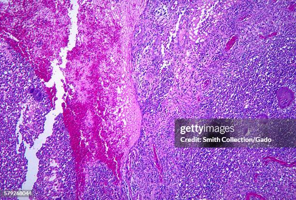 This micrograph depicts the histopathologic changes associated with actinomycetoma of the foot, 1965. Actinomycetoma is a chronic, granulomatous...