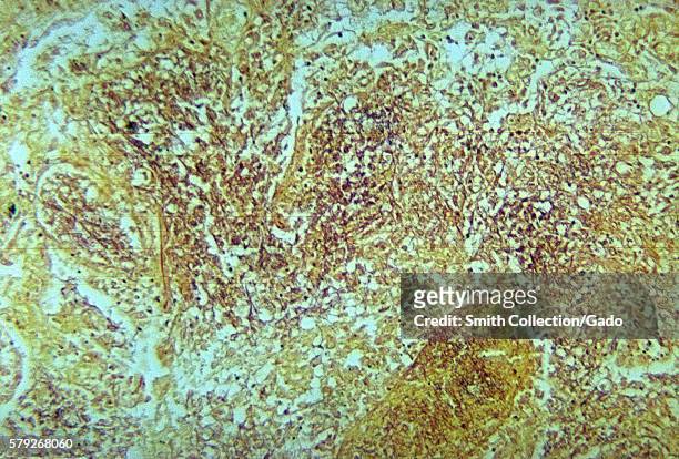 This micrograph depicts the histopathologic changes associated with nocardiosis of the lung using a Brown and Brenn stain, 1965. 80% of the cases of...