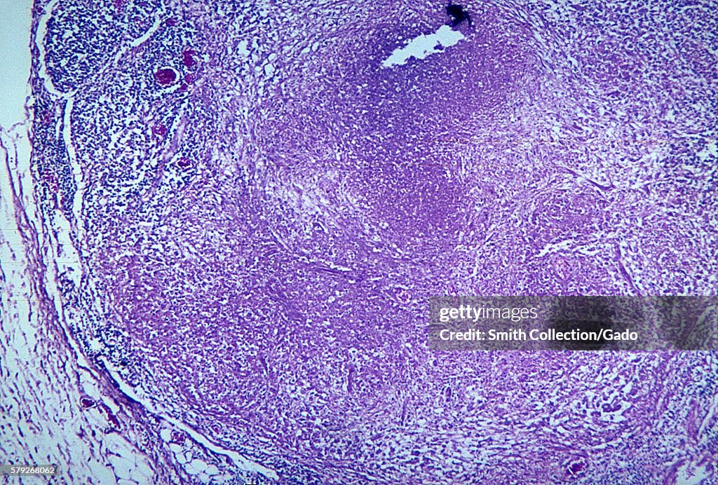 Mesenteric Lymph Node