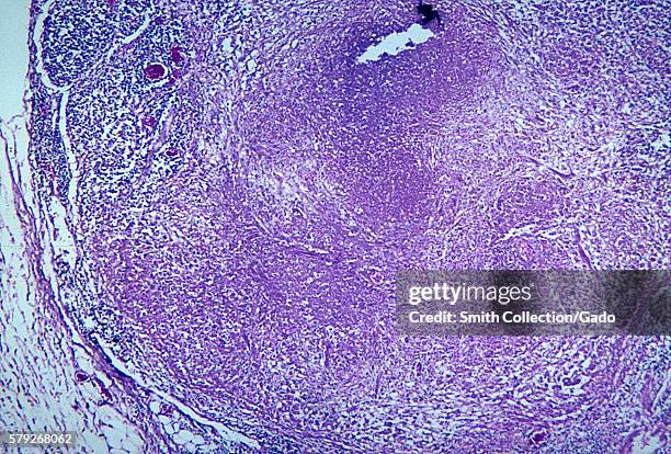 This photomicrograph depicts the histopathologic changes due to nocardiosis of a mesenteric lymph node, 1965. 80% of the cases of nocardiosis show...