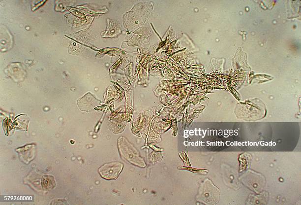 This photomicrograph of a vaginal smear identifies Candida albicans while using a wet mount technique, 1976. Candida albicans lives in numerous parts...