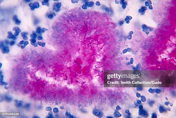 Note the presence of the gram-positive acid-fast Nocardia brasiliensis bacteria using a modified Fite-Faraco stain, 1971. 80% of cases of Nocardiosis...