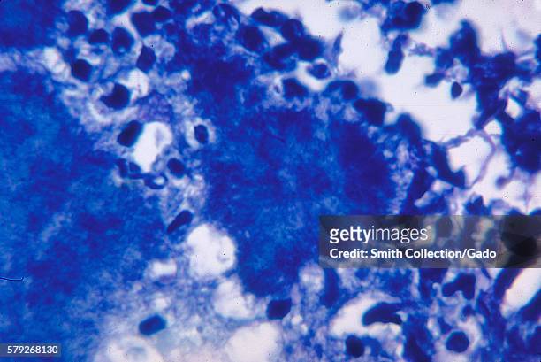 This micrograph depicts histopathologic changes due to the gram-positive organism, Actinomyces israelii, 1971. Using a modified Fite-Faraco stain, a...